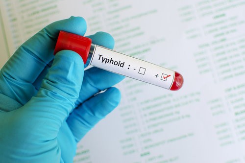 Typhoid fever : मियादी बुखार के कारण, लक्षण और आयुर्वेदिक उपचार !