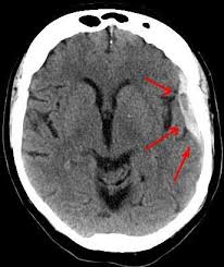 brain hemorrhage- ब्रेन हेमरेज के कारण लक्षण और उपचार

