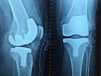 Knee pain घुटनों के दर्द का कारण और घरेलू उपाय