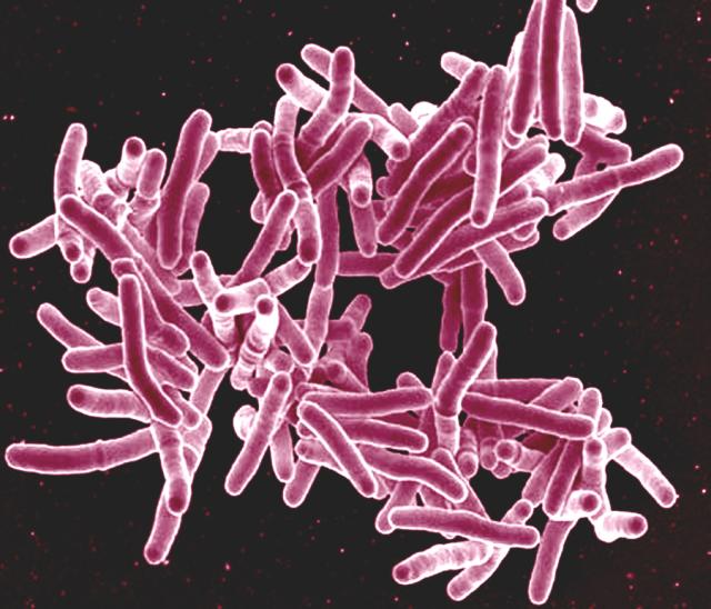 Tuberculosis टीबी, तपेदिक के कारण लक्षण निदान उपचार